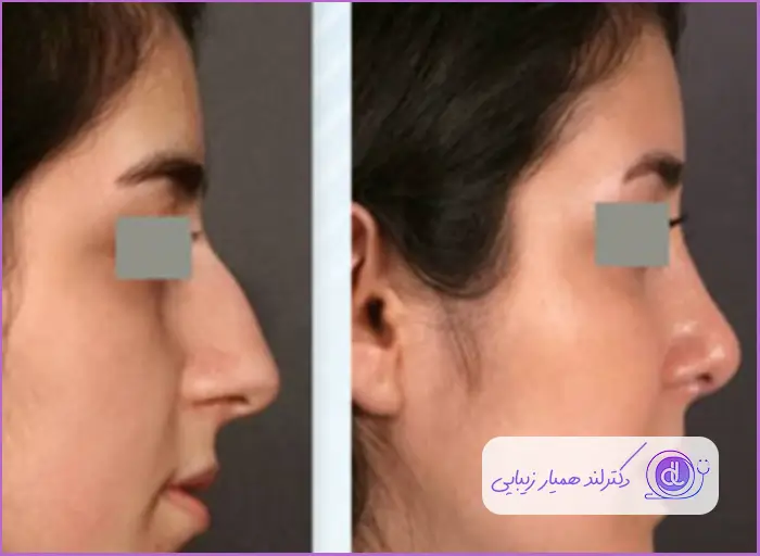 قبل و بعد عمل رینوپلاستی بینی استخوانی طبیعی زنانه دکتر مریم تهرانی