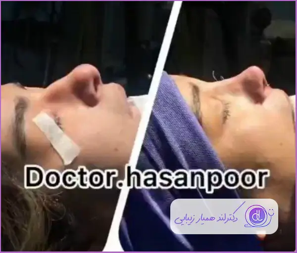 قبل و بعد جراحی بینی استخوانی به سبک نیمه فانتزی دکتر مسعود حسن پور