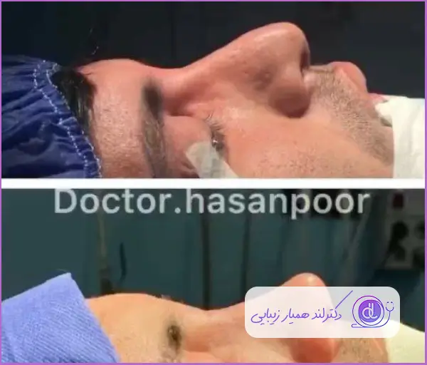 تغییرات جراحی دماغ استخوانی نیمه فانتزی مردانه دکتر مسعود حسن پور