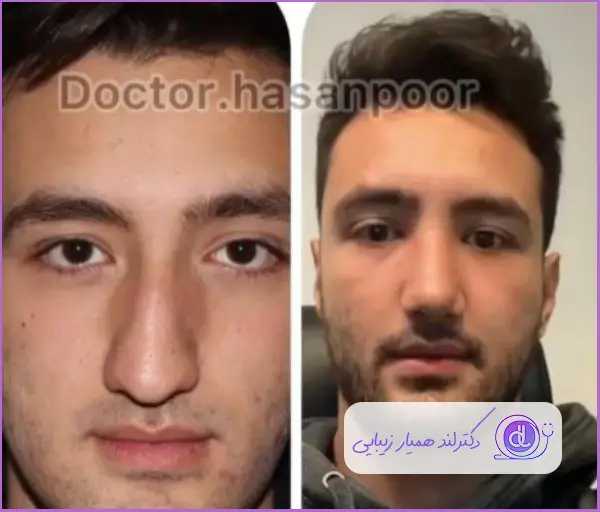 قبل و بعد جراحی زیبایی بینی گوشتی طبیعی مردانه دکتر مسعود حسن پور