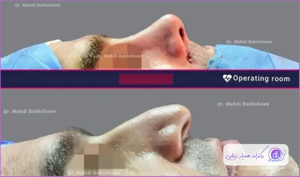 قبل و بعد جراحی زیبایی دماغ استخوانی نیمه فانتزی مردانه دکتر مهدی بخشایی