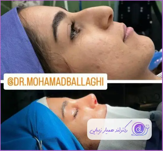 نمونه کار جراحی بینی استخوانی نیمه فانتزی زنانه دکتر محمد بلاغی