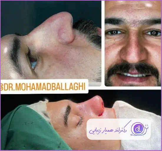 قبل و بعد عمل جراحی بینی مدل طبیعی مردانه دکتر محمد بلاغی