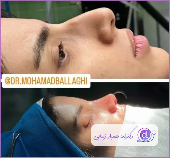 تغییرات جراحی زیبایی بینی استخوانی نیمه فانتزی دخترانه دکتر محمد بلاغی