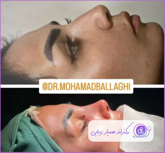 قبل و بعد جراحی بینی استخوانی نیمه فانتزی زنانه دکتر محمد بلاغی
