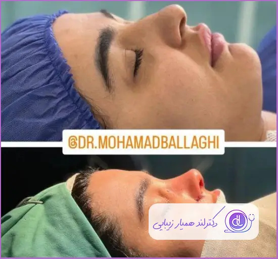 قبل و بعد جراحی بینی گوشتی نیمه فانتزی دخترانه دکتر محمد بلاغی