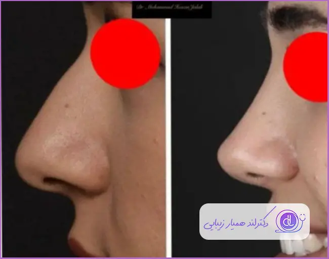 قبل و بعد جراحی زیبایی دماغ استخوانی طبیعی دخترانه دکتر محمد حسین جلالی
