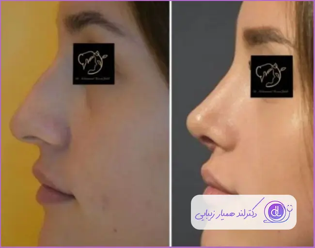 قبل و بعد جراحی بینی استخوانی نیمه فانتزی دخترانه دکتر محمد حسین جلالی