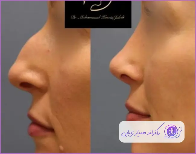 قبل و بعد جراحی بینی استخوانی طبیعی زنانه دکتر محمد حسین جلالی