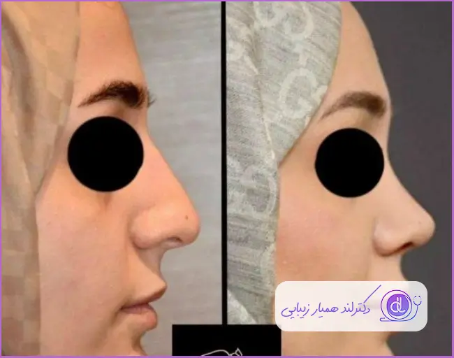 قبل و بعد رینوپلاستی دماغ به سبک طبیعی زنانه دکتر محمد حسین جلالی