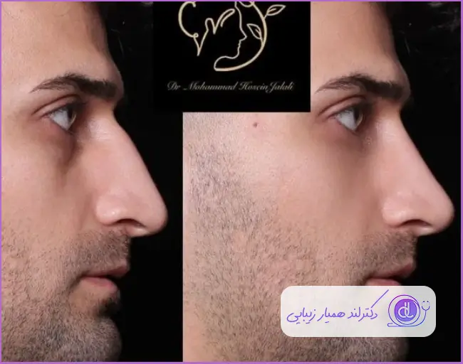 نمونه کار جراحی بینی استخوانی طبیعی مردانه دکتر محمد حسین جلالی