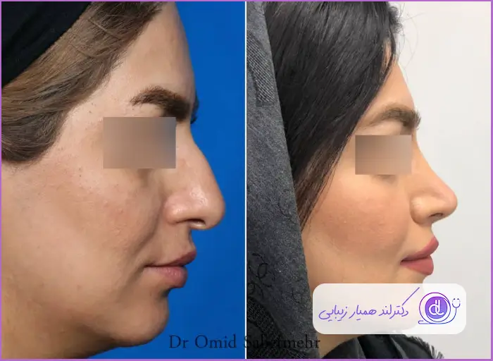 قبل و بعد جراحی بینی استخوانی نیمه فانتزی زنانه دکتر امید ثابت مهر