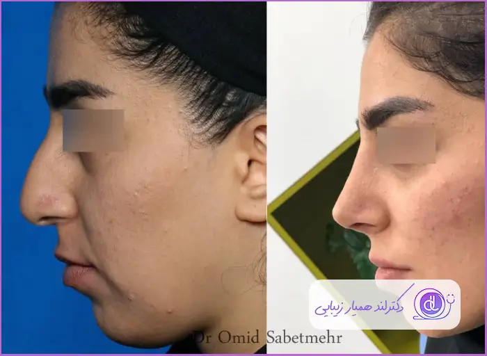 قبل و بعد جراحی زیبایی بینی استخوانی نیمه فانتزی دخترانه دکتر امید ثابت مهر
