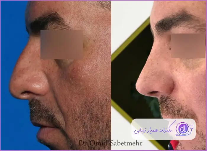 تغییرات عمل زیبایی بینی استخوانی طبیعی مردانه دکتر امید ثابت مهر
