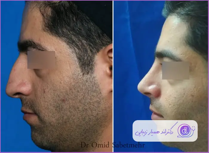 قبل و بعد جراحی بینی استخوانی طبیعی مردانه دکتر امید ثابت مهر