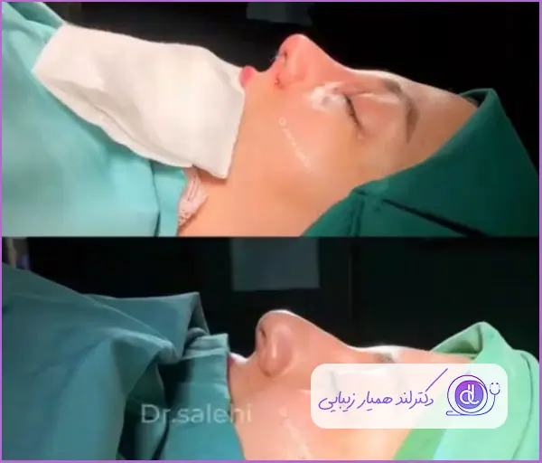 قبل و بعد جراحی بینی گوشتی نیمه فانتزی زنانه دکتر پریا صالحی