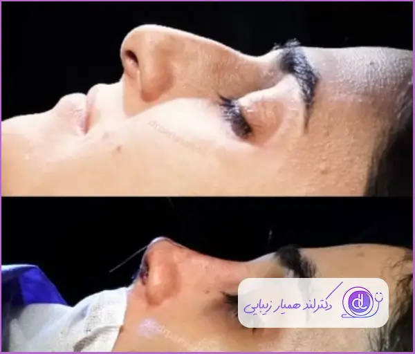 قبل و بعد عمل زیبایی بینی استخوانی نیمه فانتزی زنانه دکتر پریا صالحی