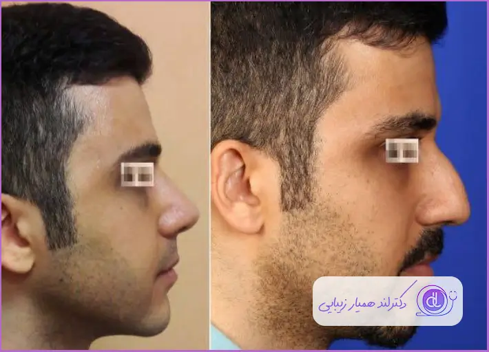 قبل و بعد عمل بینی استخوانی طبیعی مردانه دکتر پریسا قاسمی