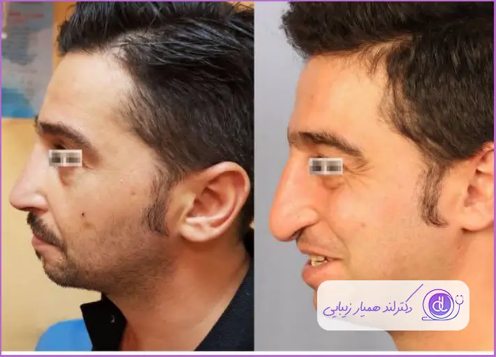 قبل و بعد جراحی زیبایی بینی گوشتی طبیعی مردانه دکتر پریسا قاسمی