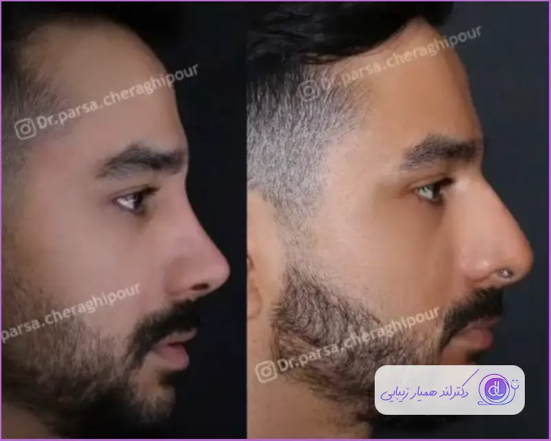 قبل و بعد عمل جراحی بینی گوشتی مردانه دکتر پارسا چراغی پور