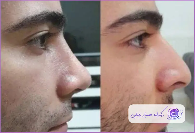قبل و بعد عمل زیبایی بینی استخوانی طبیعی مردانه دکتر پگاه علیزاده