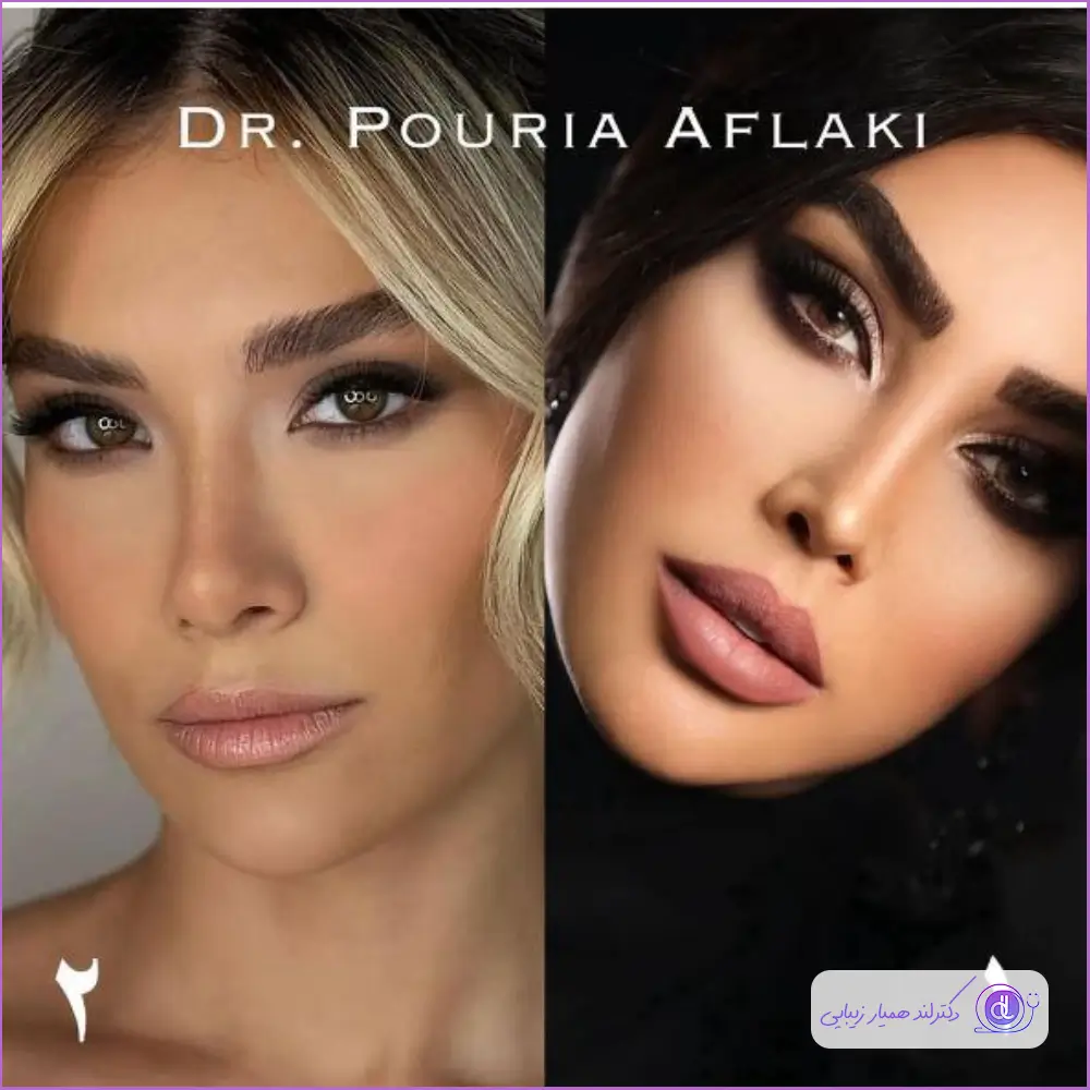 نمونه کار عمل جراحی بینی زنانه مدل طبیعی دکتر پوریا افلاکی