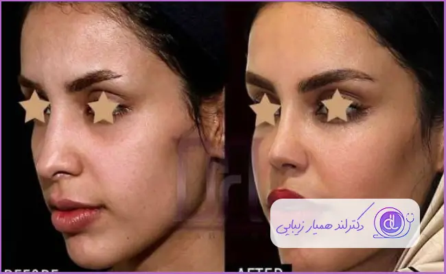 قبل و بعد جراحی بینی استخوانی نیمه فانتزی زنانه دکتر رضا افراه