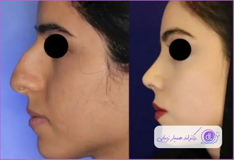 قبل و بعد جراحی زیبایی دماغ استخوانی طبیعی زنانه دکتر رضا کریمیان