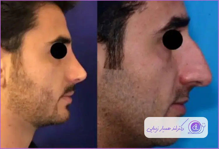 قبل و بعد عمل جراحی بینی استخوانی طبیعی مردانه دکتر رضا کریمیان