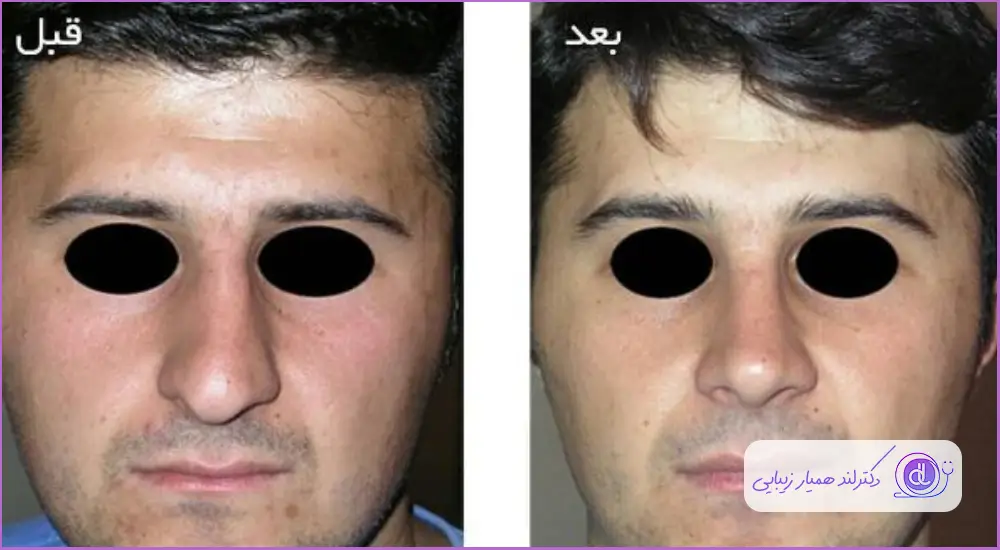 کوچک کردن بینی گوشتی مردانه دکتر شاهین فتح سامی