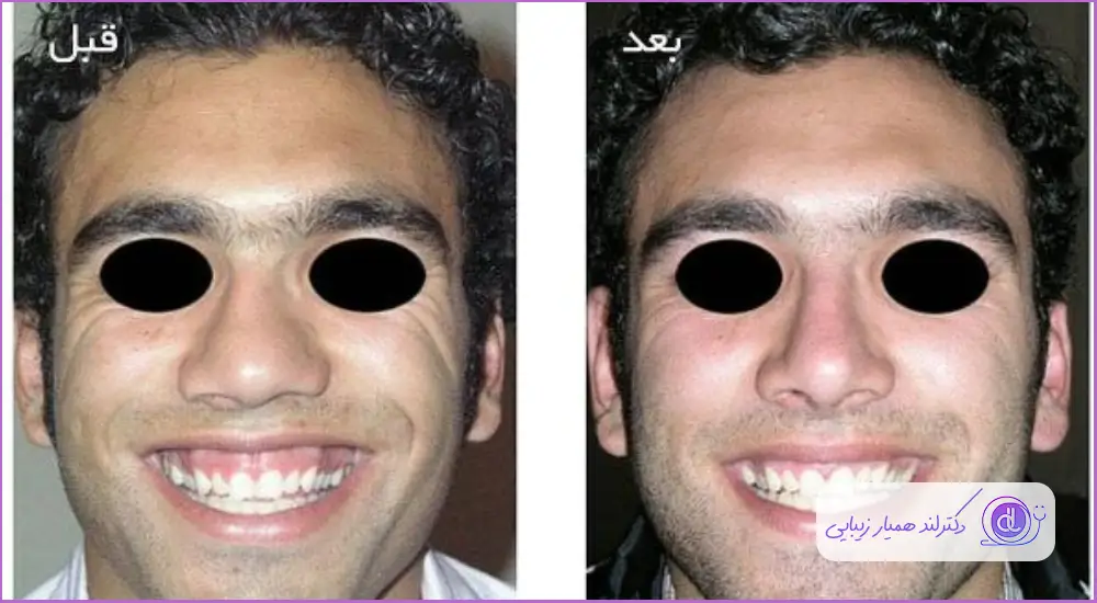 نمونه قبل و بعد عمل زیبایی بینی مردانه دکتر شاهین فتح سامی
