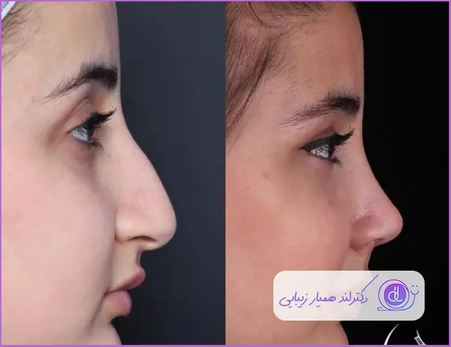 قبل و بعد عمل بینی استخوانی طبیعی زنانه دکتر سبحان پورارض