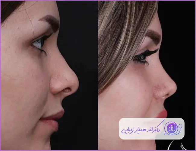 قبل و بعد عمل زیبایی بینی گوشتی طبیعی زنانه دکتر سبحان پورارض