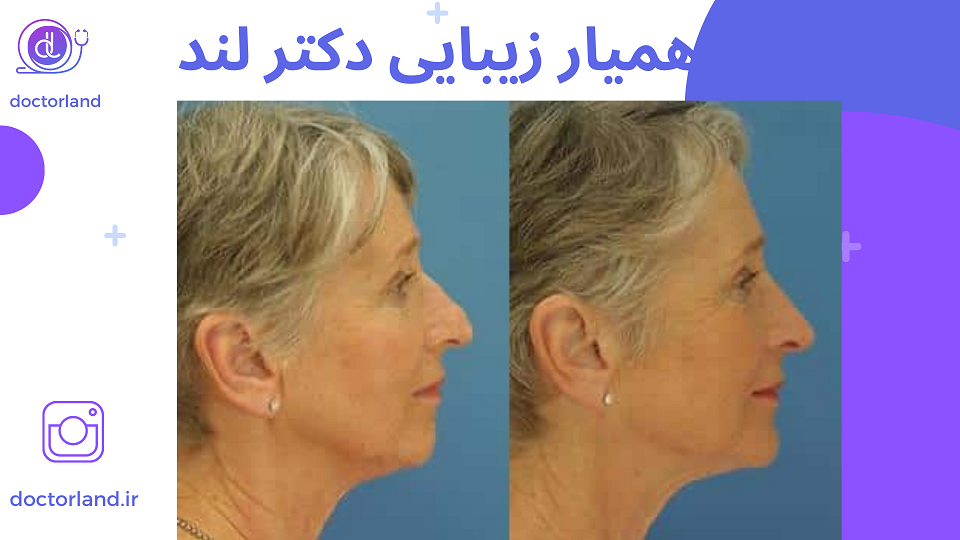 جراحی بینی در افراد مسن