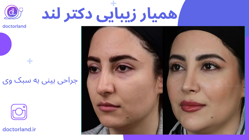 جراحی بینی به سبک V