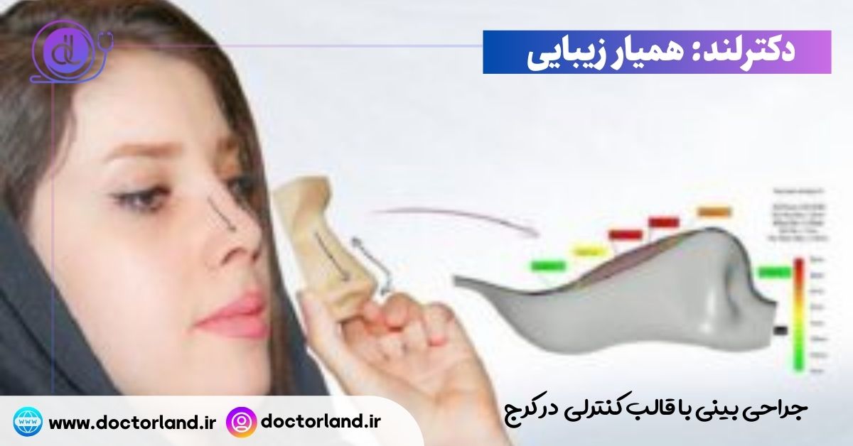 جراحی بینی با قالب کنترلی در کرج