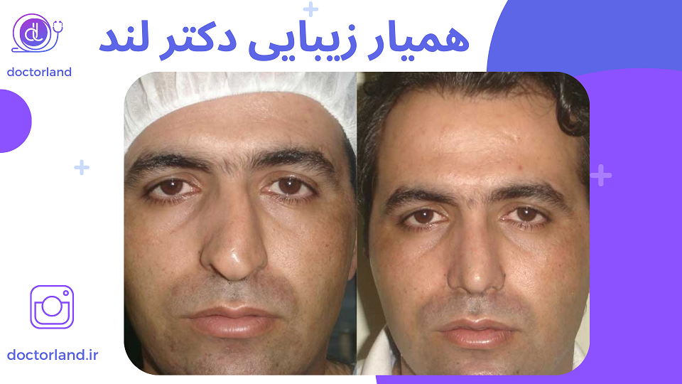 عمل انحراف بینی