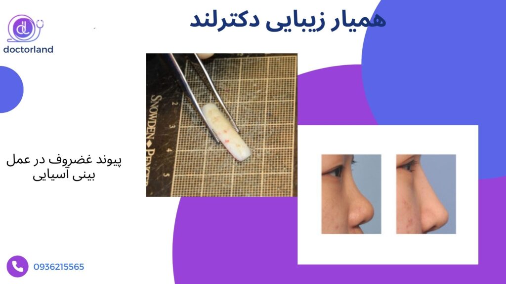 نمونه کار پیوند غضروف بینی در عمل بینی شرقی