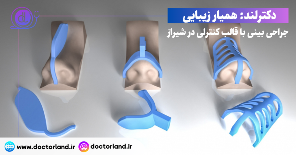 جراحی بینی با قالب کنترلی در شیراز