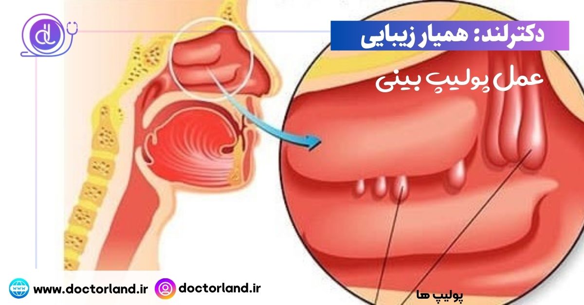 عمل پولیپ بینی