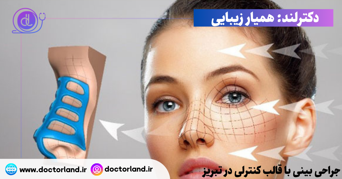 جراحی بینی با قالب کنترلی در تبریز