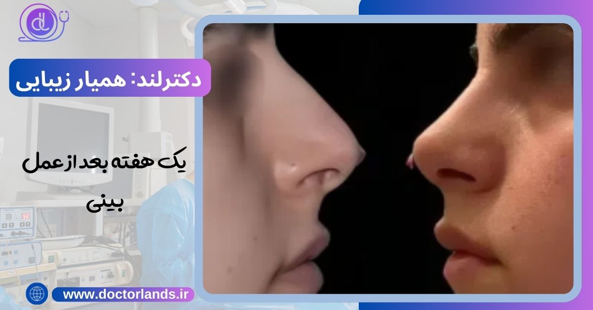 یک هفته بعد از عمل بینی 