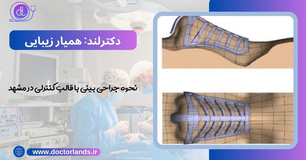 نحوه جراحی بینی با قالب کنترلی در مشهد