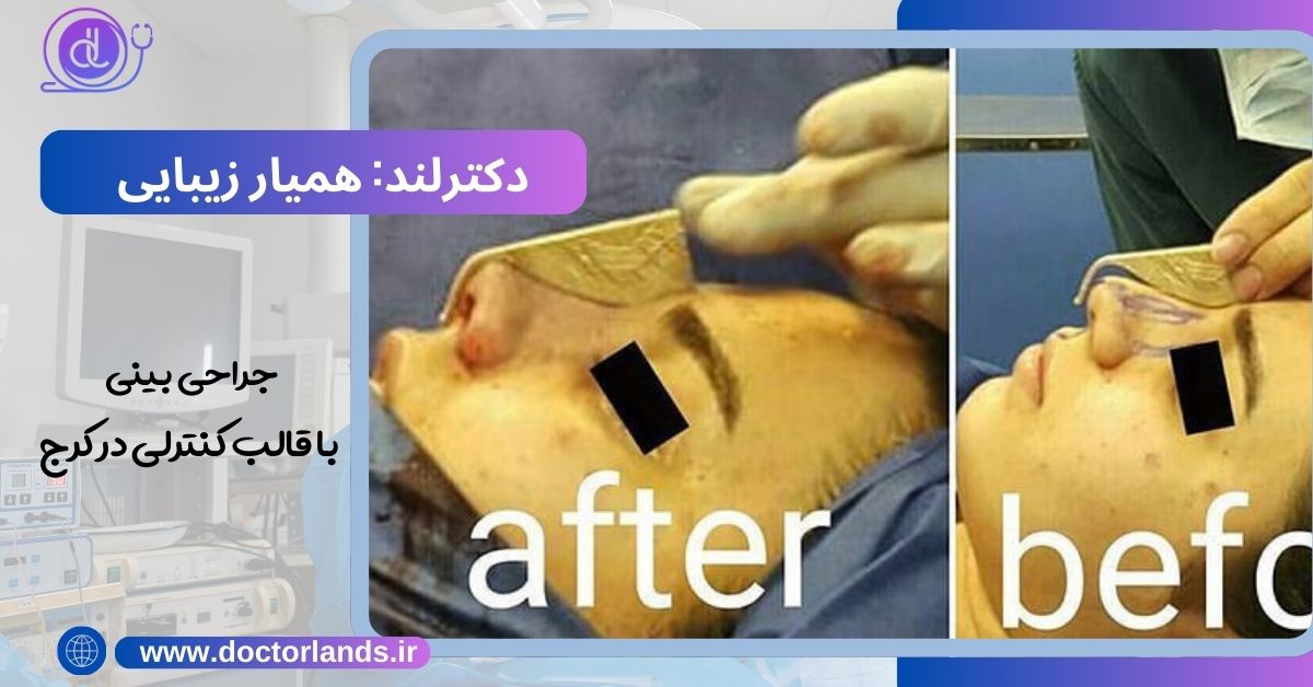 جراحی بینی با قالب کنترلی در کرج